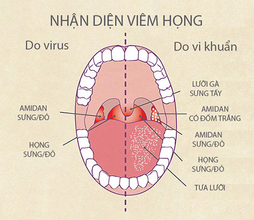 Dấu hiệu phân biệt giữa viêm họng do virus và viêm họng do vi khuẩn