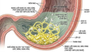 Hiện Tượng Đông Tụ Dạ Dày kêt hợp tinh bột nghệ với sữa