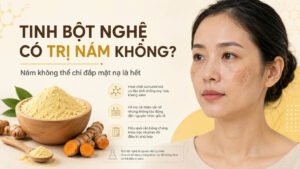 Tinh bột nghệ có trị nám không và vì sao nám không thể chỉ đắp mặt nạ là hết
