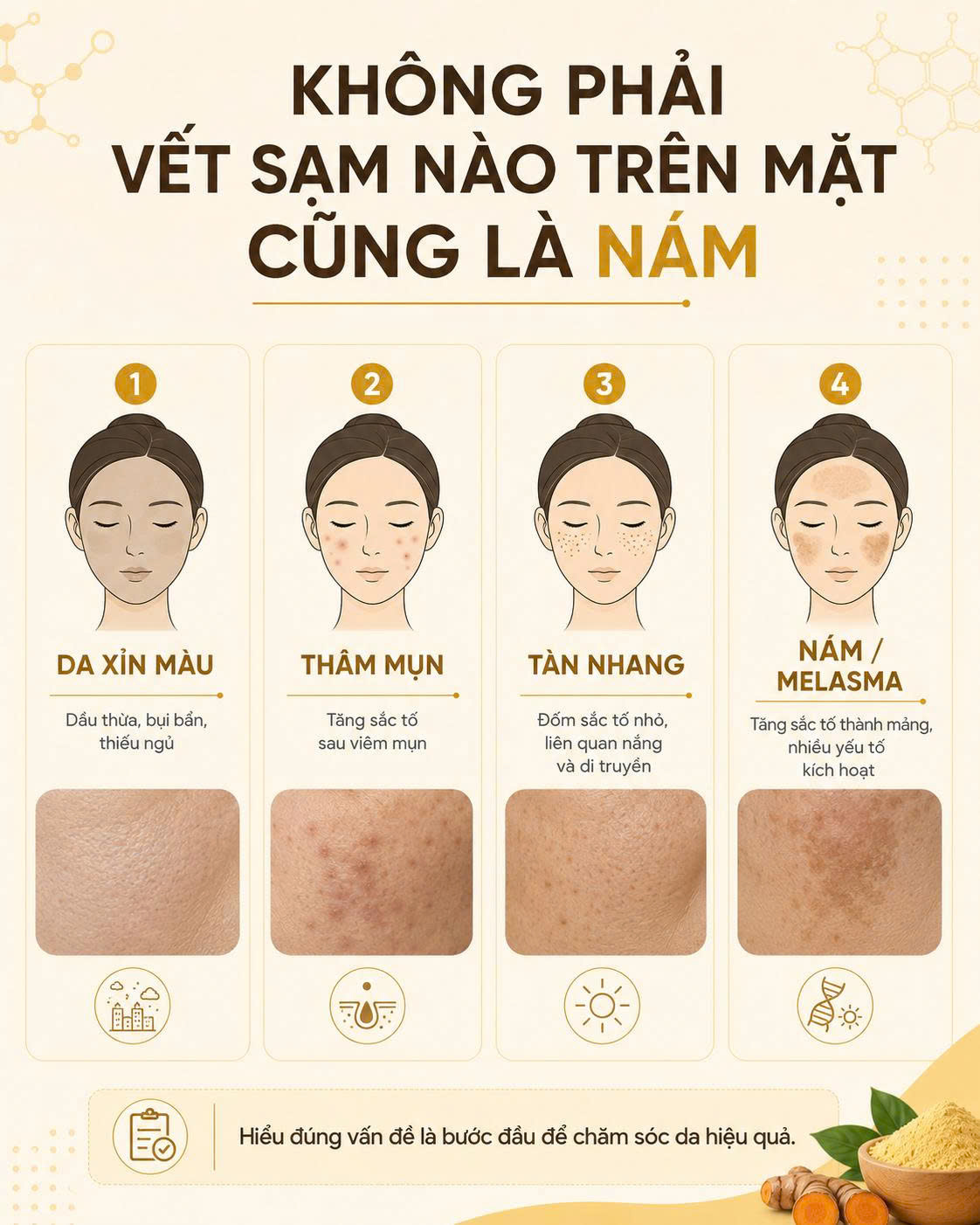 Phân biệt nám da mặt với da xỉn màu thâm mụn và tàn nhang